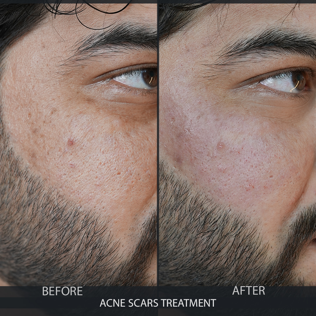 acne-031-